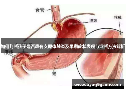 如何判断孩子是否患有支原体肺炎及早期症状表现与诊断方法解析